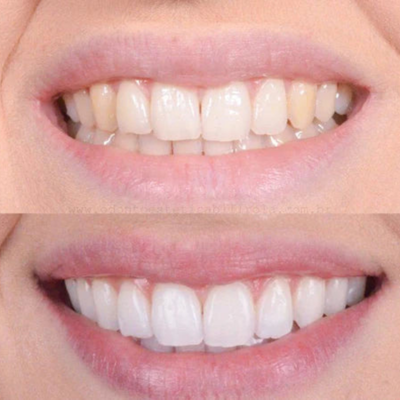 PearlWhite – Hurtig tandblegning for et strålende smil 